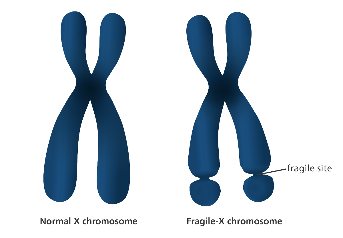 fragile-x-chromosome